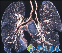 你知道什么是塵肺病嗎？使用粉塵儀可以降低塵肺病的發(fā)生率